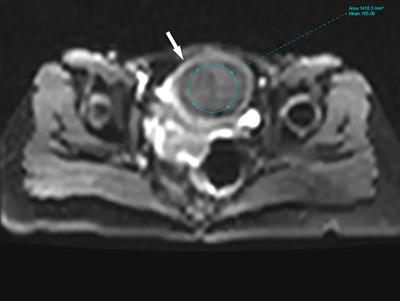 Intravoxel incoherent motion diffusion-weighted MRI for predicting the efficacy of high-intensity focused ultrasound ablation for uterine fibroids